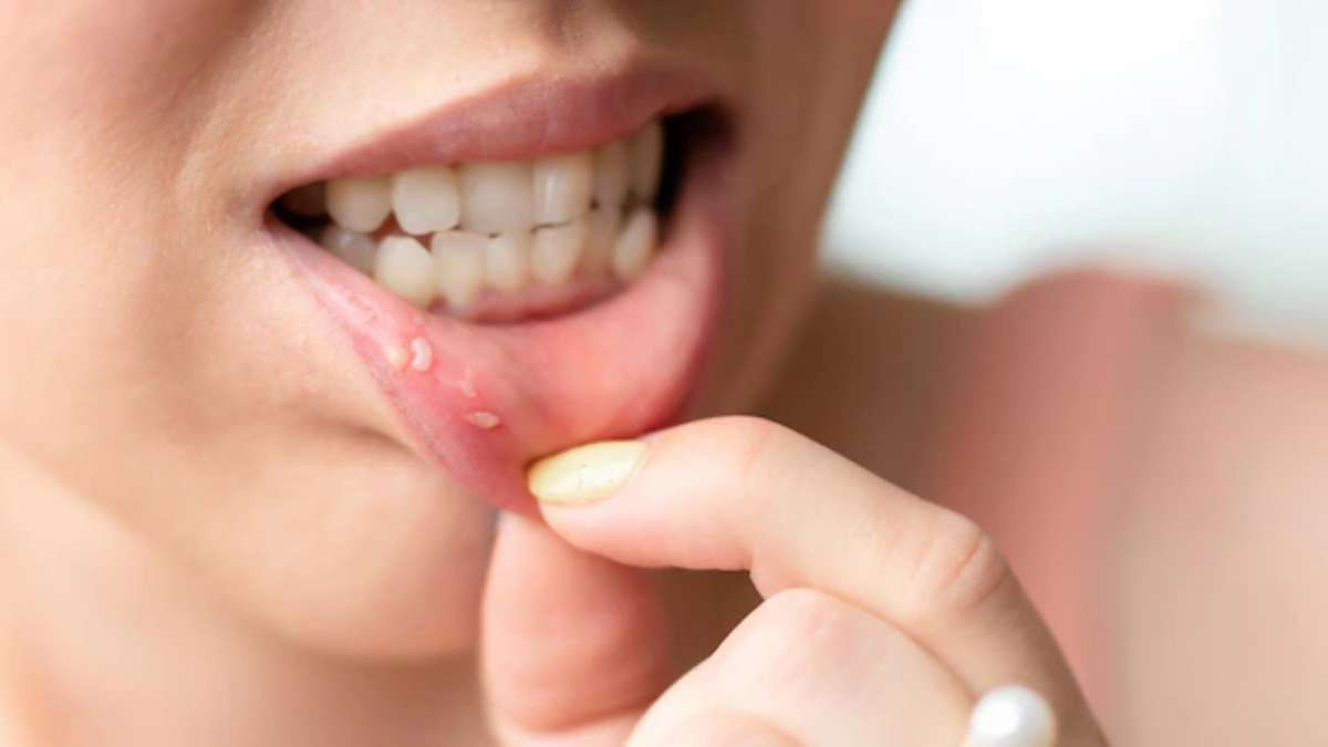 Mouth Ulcer