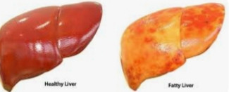 Fatty Liver