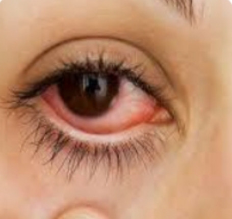 Conjunctivitis - new symptoms of corona