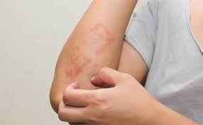 Rash-allergy restless? Here are some simple tips to recover from it