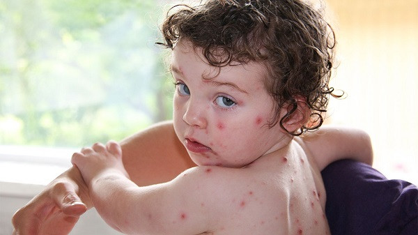 Chicken Pox (File Picture)