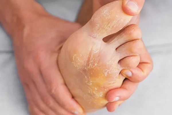 Foot Care (File Picture)