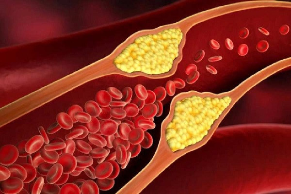 Cholesterol Control Tips (Symbolic Picture)