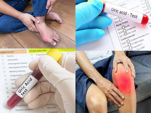 Uric Acid Pain (File Picture)