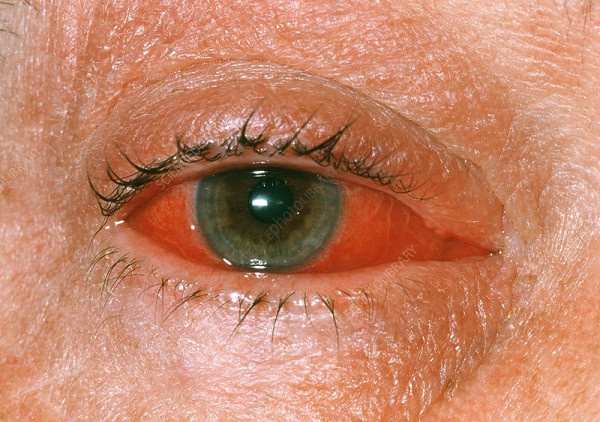 Conjunctivitis Eye Disease