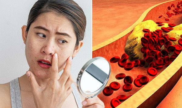 High Cholesterol Diseases
