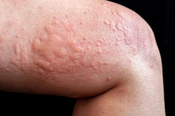 Skin allergies