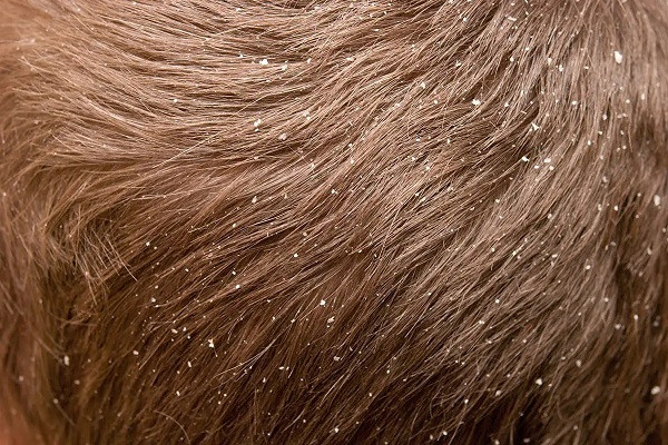 Dandruff on the head