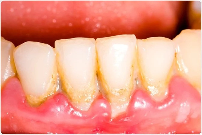 Tartar on Teeth