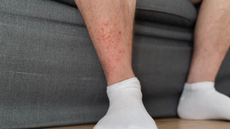 Winter Rash from Socks Can Become Infectious