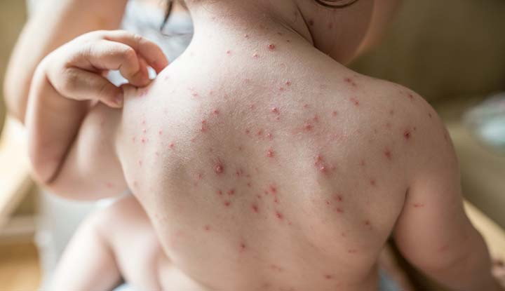Chickenpox cases spike in children