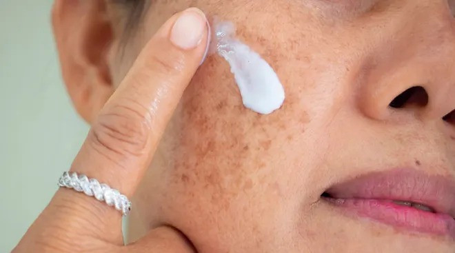 Simple remedies for Melasma