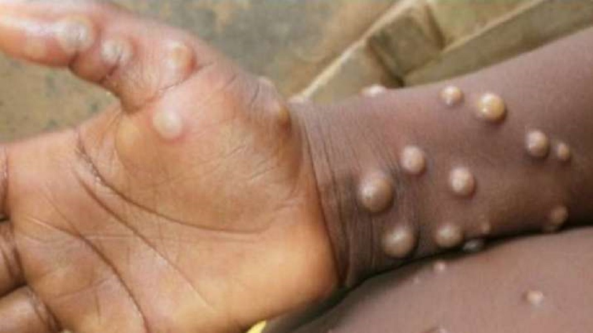 one suspected monkeypox patient found
